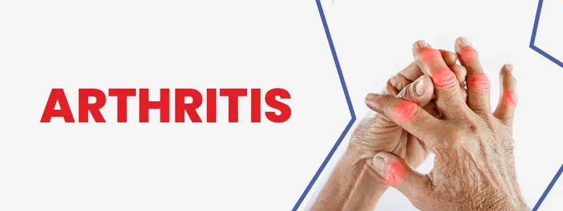 Arthtrits Treatment in India