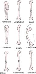 Complete fractures