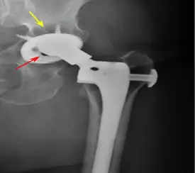 Hip Revision